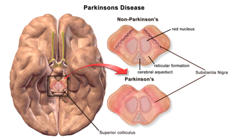 Agent Orange and Parkinson’s Disease: The Lasting Impact of Toxic Exposure