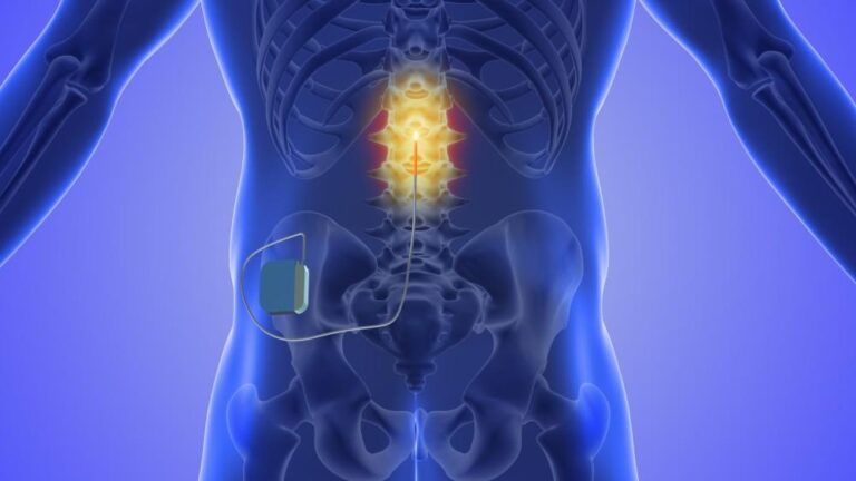 Spinal Cord Stimulator Trial