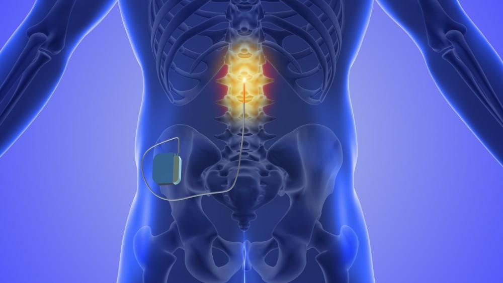 Spinal Cord Stimulator Trial